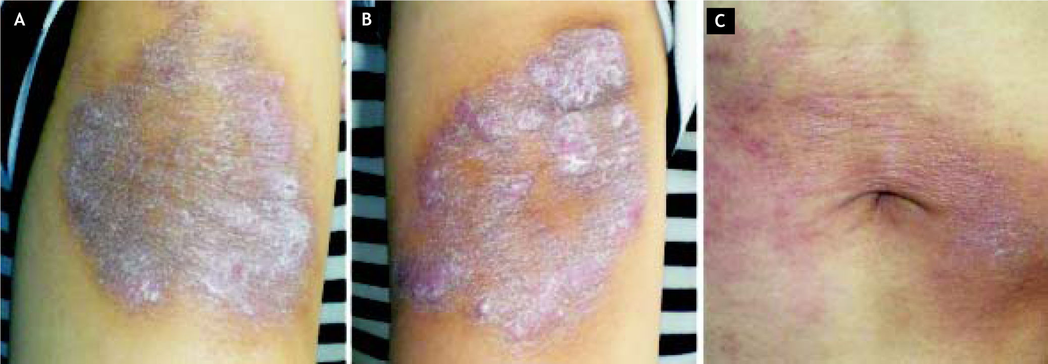 Pegylated interferon, but not conventional interferon therapy induced ...