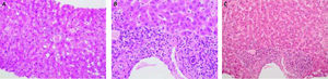Liver histology (H&E staining) from the biopsy performed during the 2nd. cholestatic phase, phase of the disease. The hepatic tissue was characterised by parenchymal inflammation and intrahepatic cholestasis, however no signs of fibrosis were detected.