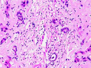 H&E stain of the hepatic tissue showing diffuse amyloid deposition. Eosinophilic amyloid materials are diffusely present in extracellular matrix, such as hepatic sinusoids, portal area, and vessel walls. Hepatic plates are distorted and hepatocytes atrophy. Original magnification: ×400.