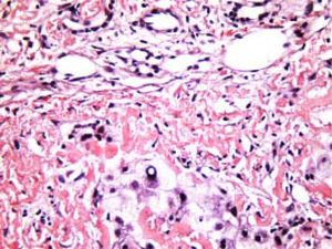 Characteristic Congo Red staining of hepatic tissue showing amyloid protein deposit in the extracellular matrix. Amyloid protein spherical bodies can be found occasionally in hepatic sinusoids and intercellular space. Rudimentary and degenerated hepatocytes are visible. Original magnification: ×400