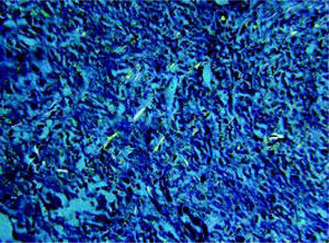 Characteristic Congo Red staining of hepatic tissue showing apple-green birefringence of amyloid by polarizing microscope. Original magnification: ×400.