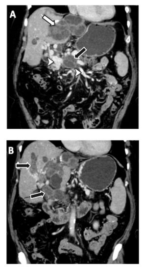 A.Multiple hepatic masses in the left liver lobe (white arrow) with portal invasion (black arrow) and secondary cavernomatosis (white arrowheads).B.Intrahepatic portal invasion (black arrows).
