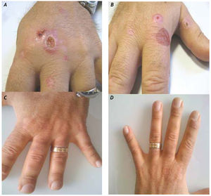 The patient presented with crusted lesions(A),vesicles, and small bullae (B)on his hands. After treatment, the lesions regressed as previously described(C-D).