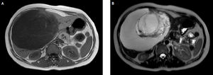 A. MRI in T1 sequence: a 18 cm cyst in the right liver. The lesion was filled with fluid and contained, in its central zone, a 7 cm heterogeneous lamellar mass. B. MRI in T2 sequence of the same 18 cm cyst in the right liver.