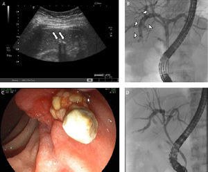 Abdominal ultrasound showed multiple small hyperechoic foci (Figure A, arrows). The cholangiogram showed trifurcation of the hilus and confirmed dilatation of the bile ducts filled with multiple small gallstones (B, arrowheads). C. Multiple small, round and yellow calculi consistent with intrahepatic cholesterol gallstones were removed from the intrahepatic bile ducts via ERCP. D. Cholangiogram after complete removal of intrahepatic gallstones.