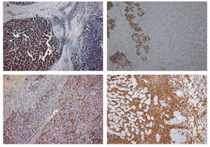 Immunohisto-chemical study of the tumor. Carcinomatous element was positive for AFP on the left (A). Nests of undifferentiated epithelial cells were positive for CK AE1/ AE3 in places, whereas the hepatocelluar carcinoma and the spindle-shaped cells were negative (B). Carcinomatous element was positive for HepPar-1 on the right (C). The spindle-shaped cells were positive for vimentin (D).