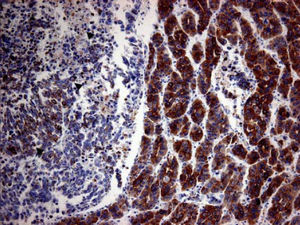 Immunohistochemical staining for CAM5.2. Diffused and strong cystoplasmic CAM5.2 staining was observed in hepatocellular carcinoma. Golgi pattern CAM5.2 staining was noted in nests of undifferentiated epithelial cells (arrowheads). (CAM5.2, x100)