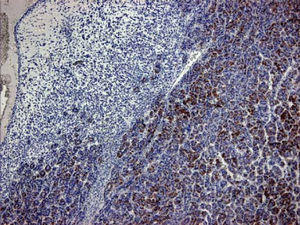 Immunohistochemical staining for TTF-1. TTF-1 cytoplasmic staining positively correlates with the trabecular pattern of well-differentiated hepatocelluar carcinomas (TTF-1, x40).