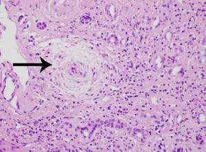 Liver biopsy shows infiltration of portal tract with lymphocytes and plasma cells, bile ducteolar proliferation, and peri-ducteolar fibrosis and edema with atrophy of cholangiocytes (arrow) (Hematoxylin and eosin, X 100).