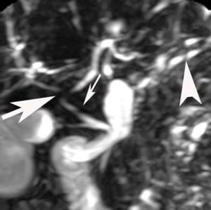 Magnetic resonance cholangiography shows beading and pruning appearance of the common hepatic duct (small arrow), intrahepatic bifurcation of common hepatic duct (large arrow) and intrahepatic bile ducts (arrow head).