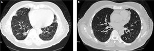 Case 2. A. HRCT scan showing bronchial wall thickening and mosaic pattern of attenuation suggestive of bronchiolitis obliterans. B. Follow up HRCT scan one year later showing complete resolution of the abnormalities.