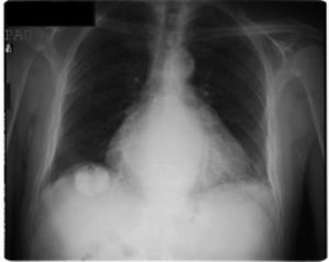 Chest radiograph disclosed a rounded calcified opacity in right upper abdomen.