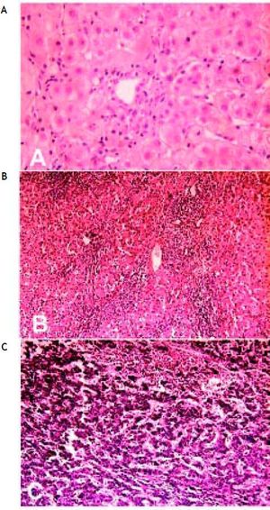 Liver pathology pre- and post-operation at first and second hospitalization. A. Liver biopsy shows only a few lymphocytes infiltration (H&E, x 200) at first hospitalization. B. Postoperative pathology shows liver cirrhosis (H&E, x 100) and C. postoperative pathology shows hepatocellular carcinoma (H&E, x 100) at second hospitalization.