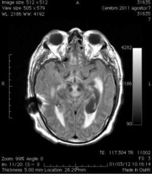 Magnetic resonance imaging of the head, revealed both, lateral and third ventricles dilated and transependymal migration of spinal fluid.
