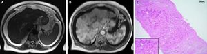 Magnetic resonance imaging of the liver and histology of transjugular biopsy. A. The T2-weighted HASTE-Sequence demonstrates massive ascites and a nodular surface of the liver together with a hypertrophy of liver segment 1. B. On the arterial phase T1-weighted image post contrast medium hypovascularized areas throughout the whole liver are noticed, indicating areas of focal fibrosis. C. Highly distorted liver architecture with extensive fibrosis and diffuse infiltration by small clusters of medium sized tumor cells (H&E, x100).