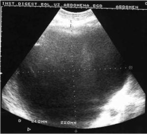 Ultrasound scan of the huge liver cyst.