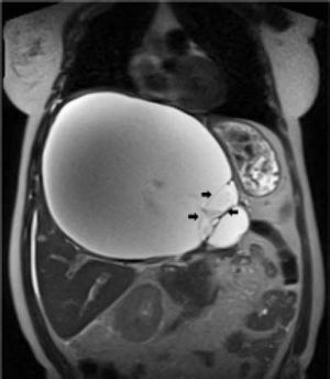 MRI demonstrating the huge cystic lesion within the liver. The arrows indicate the thin-walled septae.