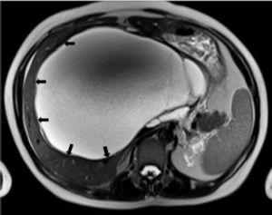 MRI demonstrating the large cystic mass compressing the adjacent normal liver tissue (arrows).