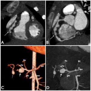 CE-MDCT image of the heart reformatted on frontal (A) and sagittal (B) plane, showing multiple aneurysmatic dilatations with rosary-like appearance in the proximal and middle tract of right coronary artery (arrows) and a fusiform aneurysm in the middle part of left coronary artery (arrow head in A). C-D. 3D volume-rendered (C) and multi-intensity projection (D) images of celiac trunk reformatted on coronal plane from abdominal CE-MDCT shows the first saccular aneurysm (thick arrow) at bifurcation of right hepatic artery (rhab) affecting the proximal part of its posterior branch and the second aneurysmal dilatation (thin arrow) distally to the first. lha: left hepatic artery; lga: left gastric artery; abrha: anterior branch of right hepatic artery; gda: gastroduodenal artery; sma: superior mesenteric artery; spa: splenic artery.