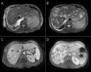 Conventional MRI images of liver metastases from small lung cell carcinoma. A, B. Fat-suppressed T2-weighted fast spin-echo images. C, D. Gadolinium-enhanced hepatic arterial dominant-phase 3-dimensional gradient-echo. Multiple areas of distinctly hyperintensity suggesting the possibility of metastases are seen on T2-weighted image (A-B) and on gadolinium-enhanced images (C-D). Notice the increase in number and size for most lesions in the 2-months follow-up (B-D).