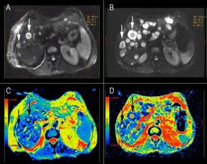 Diffusion weighted (DW) images of the liver in a patient with metastatic small cell lung cancer. A, B. DW images (b value, 500 s/mm2) showing multiple areas of hyperintensity from metastatic lesions. C, D. ADC maps of the correspondent DW images; it is possible to identify the variability in the intensity-dependent colouring of some metastatic lesions, showing a darker cell-dense rim and a colored necrotic center (white arrows). B-D DWI image and ADC map from the follow-up evaluation.