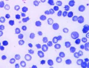Peripheral blood smear demonstrates poilikocytosis and abundant acanthocytes or spur cells, as indicated by their deformed shape and spike-like projections, which need to be differentiated from scratch artifacts.