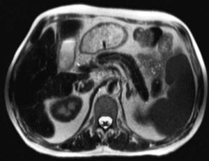 Axial T2-weighed abdominal magnetic resonance image (MRI) at the level of pancreatic body and tail. Note the homogeneous hypointense signal of the liver and pancreas indicative of diffuse parenchymal iron overload as in primary hemochromatosis. Likewise, but less pronounced, the spleen displays a hypointense signal, consistent with reticuloendothelial iron deposition, thus giving rise to a mixed-pattern of iron overload.