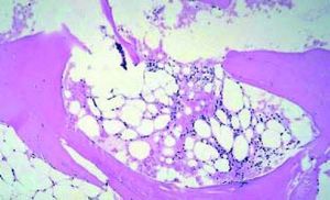 At the time of admission, a bone marrow biopsy specimen was taken from the left posterior iliac crest which demonstrated a hypocellular marrow characteristic of aplastic anemia, hematoxylin and eosin stain, x100.