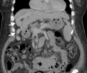 Coronal CT demonstrating a large recanalised umbilical vein (arrows).