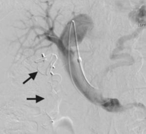 Successful occlusion of the umbilical vein after deployment of 2 Amplatzer Vascular Plugs (arrows).