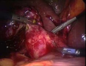 Intraoperative finding of unexpected Mirizzi’s Syndrome Type 1.