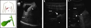 Ultrasonographic appearance of biliary sludge, gallstones, and gallstone plus biliary sludge in the gallbladder. The left cartoons depict the site of the oblique ultrasonographic scan at the right hypochondrium (top) and the resulting longitudinal section of gallbladder. A. A finely echogenic, dense, gravity-dependent, slowly mobile biliary sludge is seen occupying about 40% of the gallbladder lumen (thick arrows). The thickness of the gallbladder wall is not increased. B. Two mobile echogenic gallstones are indicated within the gallbladder lumen, layering on the distal wall. Each stone size is about 0.5 cm in diameter. C. A 1.5 cm gallstone in diameter (arrow) is detected in the gallbladder infundibulum and is surrounded by biliary sludge (triangle). The asterisk indicates the posterior acoustic shadowing typical of gallstones.