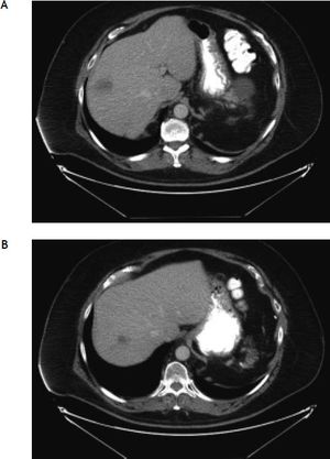 A and B. Abdominal CT scan revealed multiple hypodensities in the liver, which were suspicious for metastatic disease.