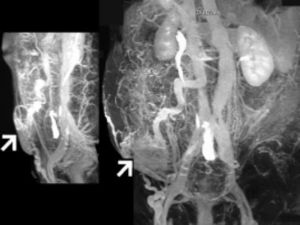 Sagittal and antero-posterior CT angiographic images, showing large dilation of portal vein and superior mesenteric vein, with rich system of collateral veins at level of ileal conduit (arrow).