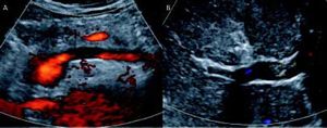 Doppler ultrasonography image of total portal vein thrombosis with absence of blood flow through the vessel is seen in A. Partial portal vein thrombosis is shown in B.
