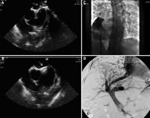 PFO definition/occlusion and post-TIPS portal vein patency in case 2. A. Intracardiac contrast enhanced (agitated normal saline) echocardiography demonstrating PFO. The white arrow indicate the passage of normal saline in left atrium. B. Intracardiac echocardiography demonstrating correct release of the Amplatzer Occluder (white arrow) across PFO. C. Angiographic confirmation of correct release of the Amplatzer Occluder and adequate PFO occlusion (also confirmed by intracardiac contrast enhanced echocardiography), indeed no contrast medium and normal saline leakage in left cavities was observed. D. Angiography demonstrating post-TIPS patency of the portal vein. The black arrow indicate the previously implanted Amplatzer PFO Occluder.