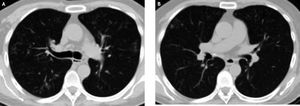 Axial chest computed tomography (CT) scan (lung windows). Bilateral nodular opacities are present with centrilobular distribution, some with branching morphology (tree-in bud), consistent with distal airway inflammation and/or endobronchial spread of infection (A and B).