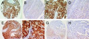 Immunohistochemical analysis of SPHK1 expression in HCCs and the adjacent non-tumorous liver tissues (A-H). Immunohistochemical staining of paired HCC and non-tumoral tissue (A-D). Hepatocellular carcinoma cells in HCC were strongly positive for SPHK1 expression in the cytoplasm and on the cell membrane (A, C). Normal hepatocytes in the non-tumoral tissue showed no detectable SPHK1 expression (B, D). Immunohistochemical staining of another paired HCC and non-tumoral tissue (F, H). HCC cells were strongly positive for SPHK1 expression (E, G). Normal hepatocytes in the non-tumoral tissue showed no detectable SPHK1 expression (F, H). Original magnifications: x 100 (A, B, E, F); x 200 (C, D, G, H).
