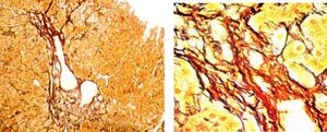 Anatomopathological liver specimen of case 1 (reticulin stain). A. Portal tract with stromal collapse and short peri-portal fibrosis (reticulin stain 100X). B. Periportal fibrous tract without mononuclear inflamatory activity (Reticulin stain 400X).