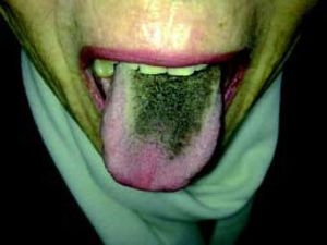 Elongated phylliform papillae and black coloration on the surface of the tongue in a 64-year-old woman with HCV infection during antiviral treatment with PEG-IFNα2a and ribavirin.