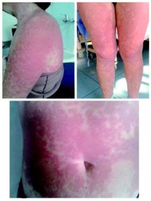 Telaprevir-associated rash severity. Eczematous and itchy lesion involving >50% of body surface area.