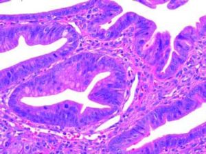 Higher magnification of biliary-type epithelium with moderate- and high-grade dysplasia in situ adenocarcinoma, characterized by nuclear pseudostratification, prominent nucleoli, and mitotic figures.