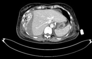 Abdominal CT scan with i.v. contrast medium injection showing a huge hepatic haematoma with laceration of the right liver lobe and hyper dense fluid in the peritoneal cavity and liver parenchyma, suggesting acute blood collection.