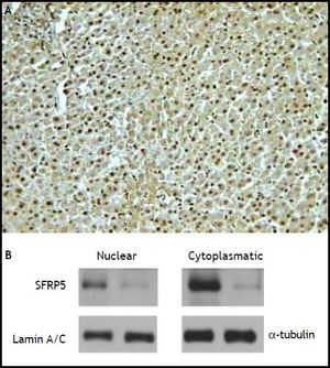 Cellular localization of SFRP5 in hepatic tissue. A. A representative example of SFRP5 immunoblotting in hepatic tissue of a non-NASH subject, immunoreactivity is present in both nuclei and cytoplasm (200x magnification). B. SFRP5 immunoblotting in nuclear and cytoplasmic fractions from hepatic tissue (two representative examples).