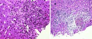 Liver histology shows portal edema and early fibrosis associated with bile ducts damage, cholestasis, cholangiolar proliferation and accompanied by neutrophils infiltrates (A) and bile infarct (B).