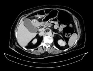 Abdominal CT revealing a linear radiopaque structure in the fourth segment of the liver.