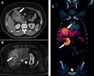 A. CT-scan showing a 10-cm of diameter, exocentric, well-defined tumor (arrow) with an exocentric cystic degeneration region compromising the 2nd portion of the duodenum. B. MRI showing multiple bilateral hyper vascular lesions (arrow) consistent with a metastatic involvement. Size of the major lesion was 6.5 cm. C. Ga68-DOTATATE PETCT showing a duodenal tumor (lower arrow) with an overexpression of somatostatin receptors and multiple metastatic lesions of similar characteristics on the liver (upper arrow).