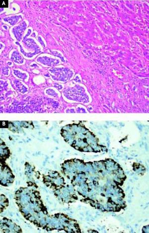 A. Liver specimen showing normal liver tissue to the right and neoplastic tissue to the left, confirming the presence of metastatic involvement of the liver. B. Immunohistochemistry for synaptophysin showing a positive reaction of the neuroendocrine cells of the tumor.