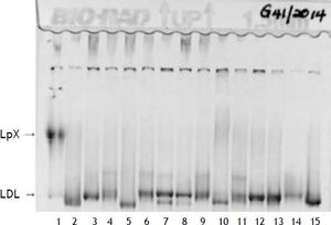 Polyacrylamide non-denaturing gradient gel lipoprotein electrophoresis. Lane 1, patient sample. The LpX band is of narrower size range than VLDL and often found in the mid region (as above). The LDL species in this patient of intermediate size and very low concentration (estimate of < 0.5 mmol/L).