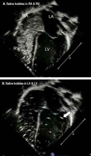 A.Echocardiography in 4-chamber view demonstrates dense agitated saline bubbles in right atrium and right ventricle. B. After 3 cardiac cycles, these saline bubbles appeared in left atrium and left ventricle (arrow).